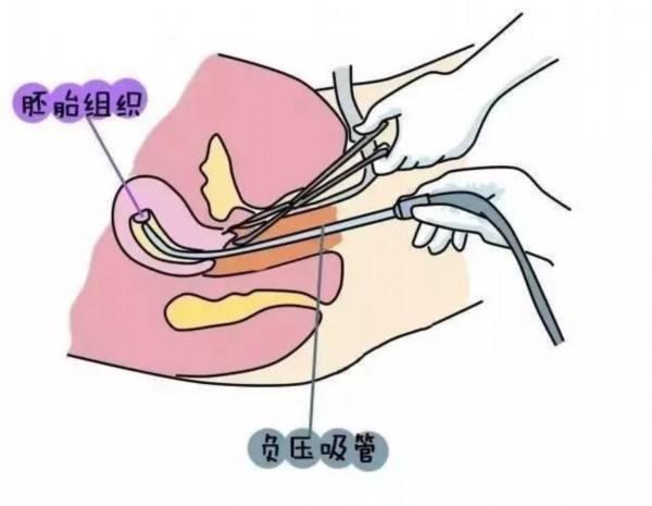 人流前一天同房了怎么办 人流之后第一天同房了怎么办