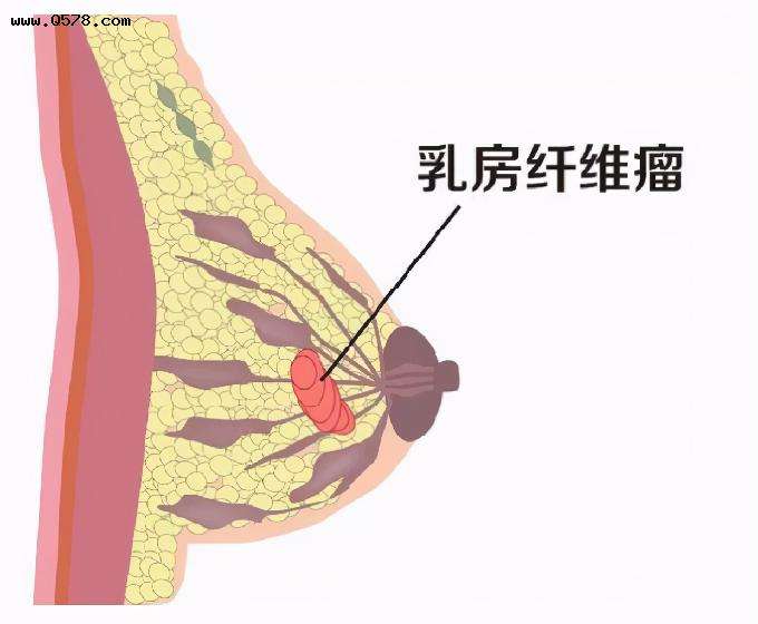 产妇乳房硬块 产妇乳房硬块通奶手法