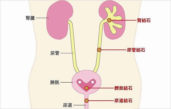 肾结石有什么症状 肾结石有什么症状腰疼与肾结石鉴别