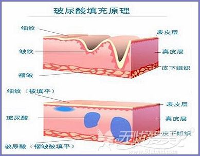 玻尿酸是什么 玻尿酸是什么样的图片