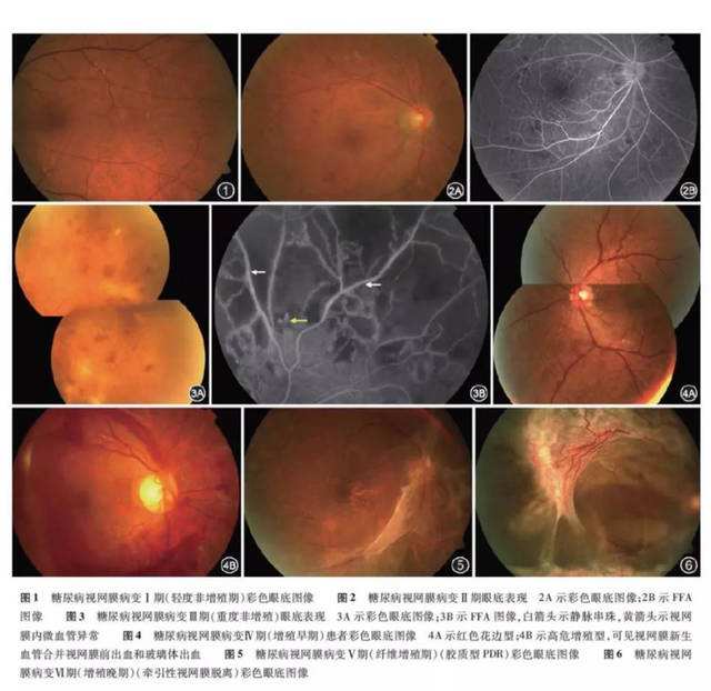 眼底疾病 眼底不好最后会失明吗