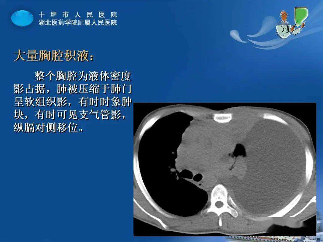 胸膜疾病 胸膜疾病或心血管疾病不会出现咳嗽