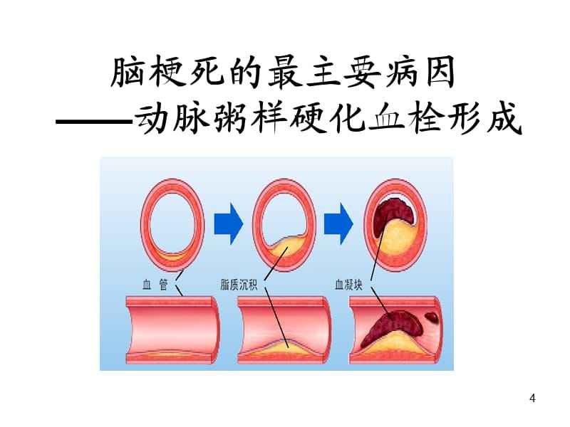 如何治疗脑梗塞 如何治疗脑梗塞左胳膊不能动