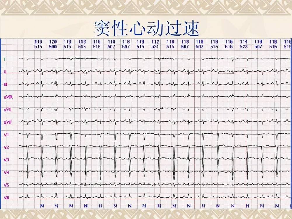 窦性心动过速是什么意思 心电图窦性心动过速是什么意思