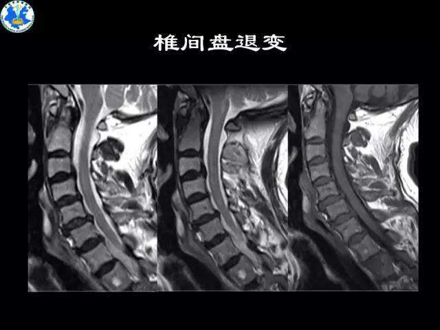 脊柱退行性疾病 脊柱退行性疾病中期应选用的方药为