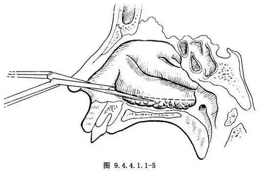 空鼻症是什么症状 空鼻症是什么症状怎么确定