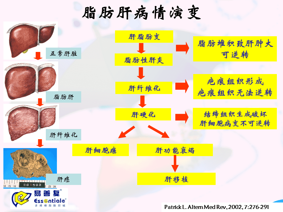 脂肪肝如何治疗 严重脂肪肝如何治疗