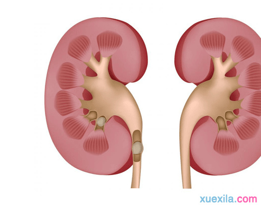 如何治疗肾结石 如何治疗肾结石疼痛