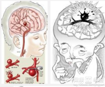 如何治疗脑梗塞 如何治疗脑梗塞最好