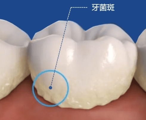 龋齿个人护理 龋齿的护理诊断